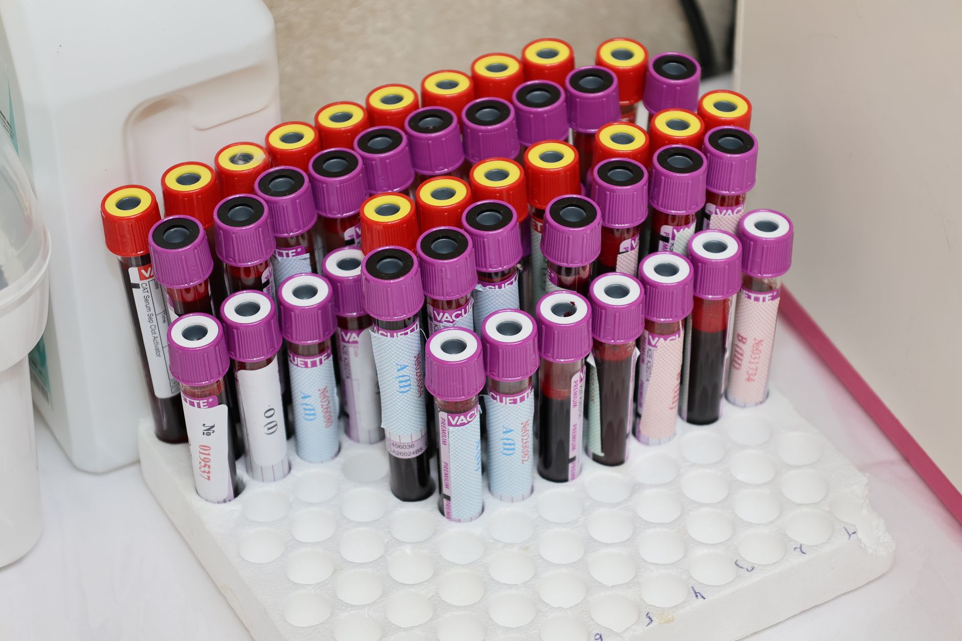 Labeled blood sample tubes in a laboratory rack used for inflammatory marker tests