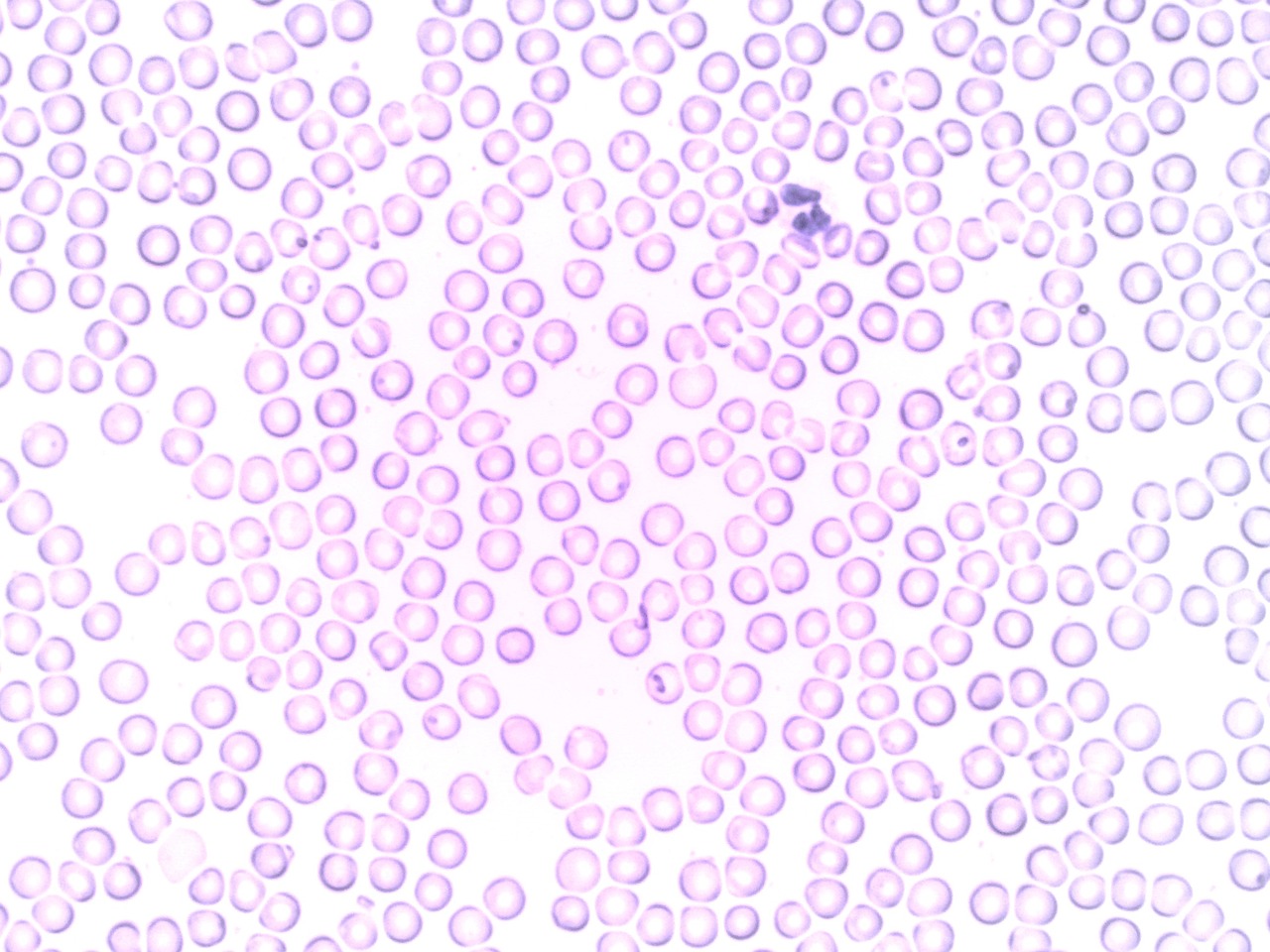 Blood smear under a microscope showing a neutrophil, a white blood cell, among red blood cells